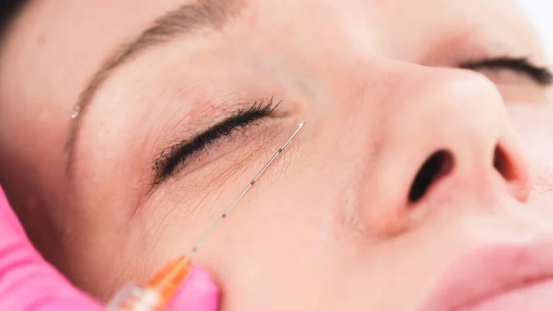 Aesthetic supplies USA. Teosyal Tear Trough: Techniques for Under-Eye Rejuvenation