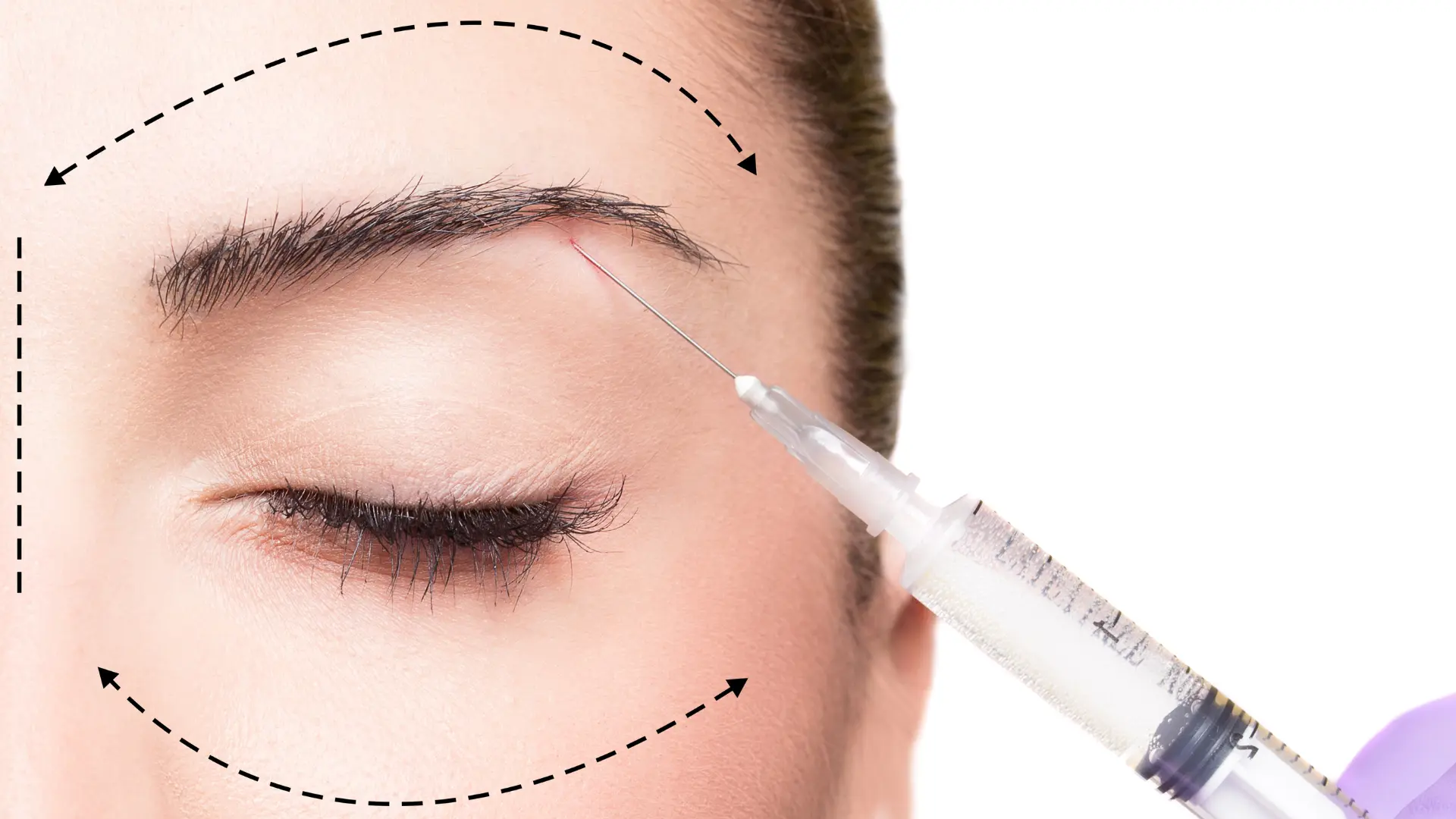 Aesthetic supplies USA. Profhilo Before And After Eyes – Photo Examples Included